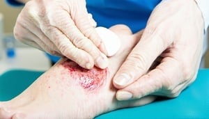 Wound treatment 